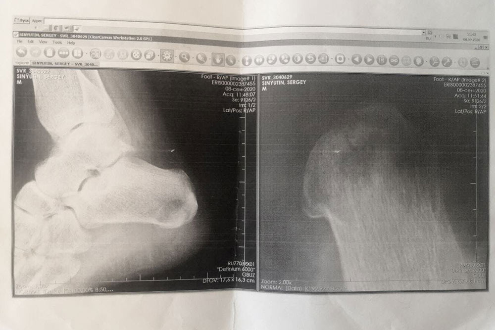 Рентген пятки после заживления