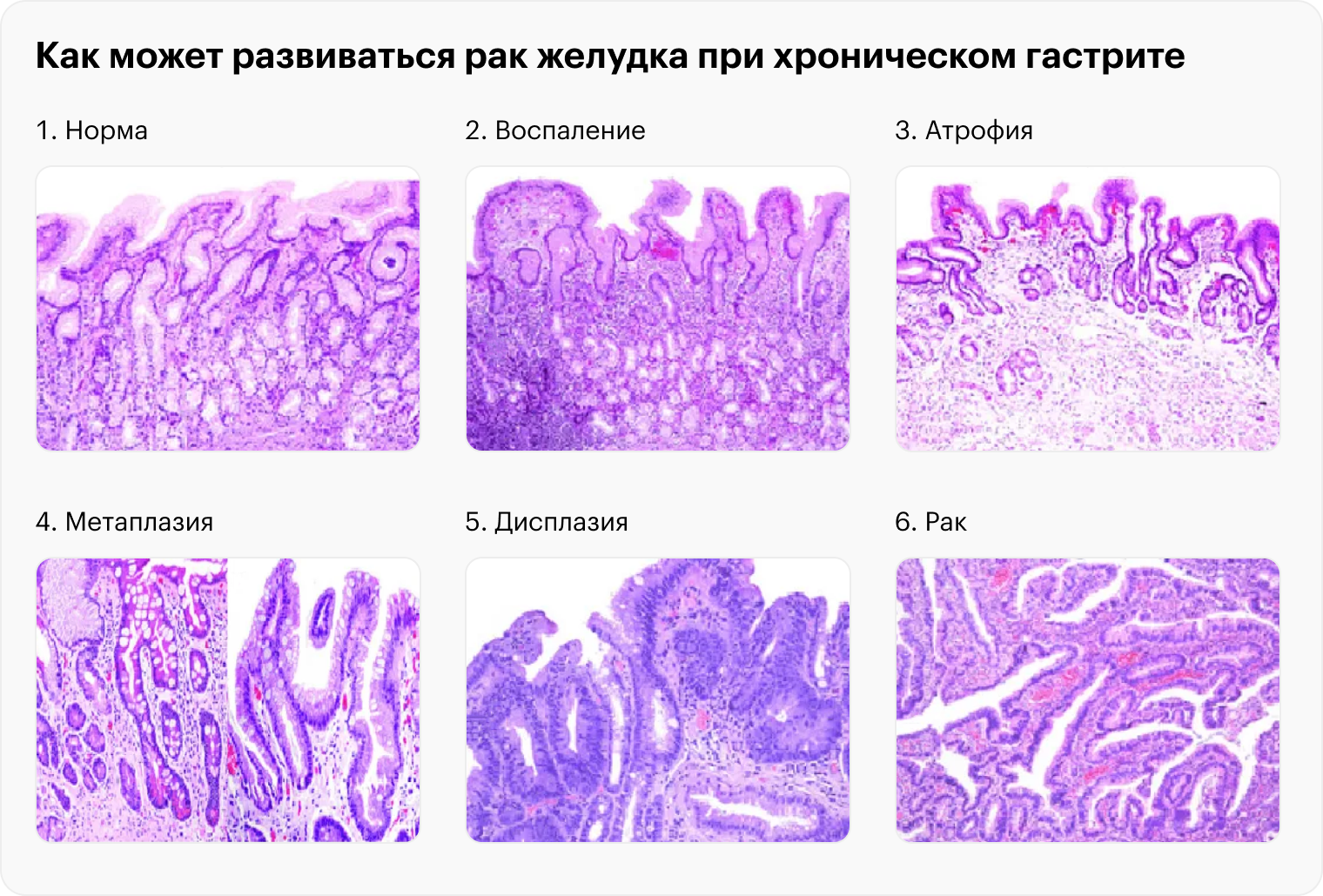 Так может развиваться рак желудка при хроническом гастрите. Длительное воспаление вызывает атрофию клеток, потом их предраковые изменения — метаплазию и дисплазию, а в итоге рак