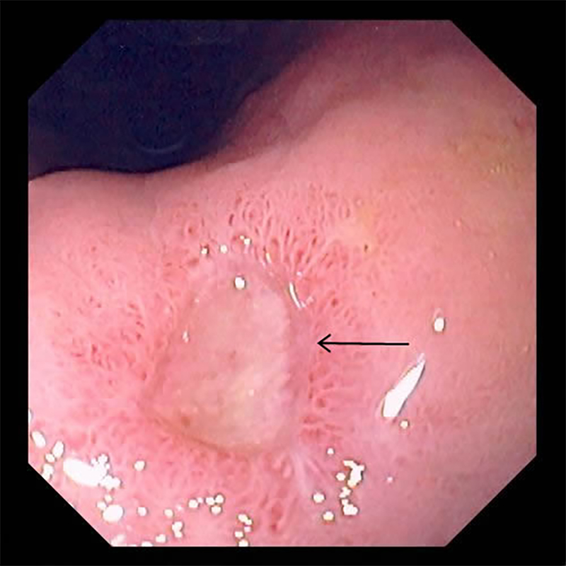 Так выглядит язва на слизистой оболочке желудка или двенадцатиперстной кишки. Источник: справочник MSD