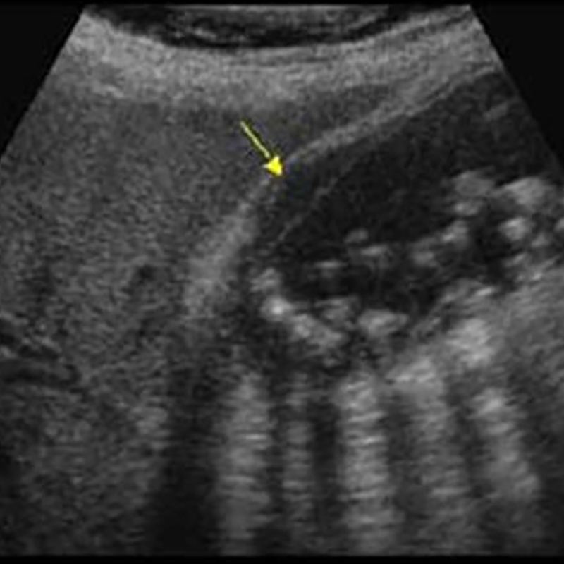 Множественные плавающие камни в желчном пузыре на УЗИ. Источник: Ultrasound Cases