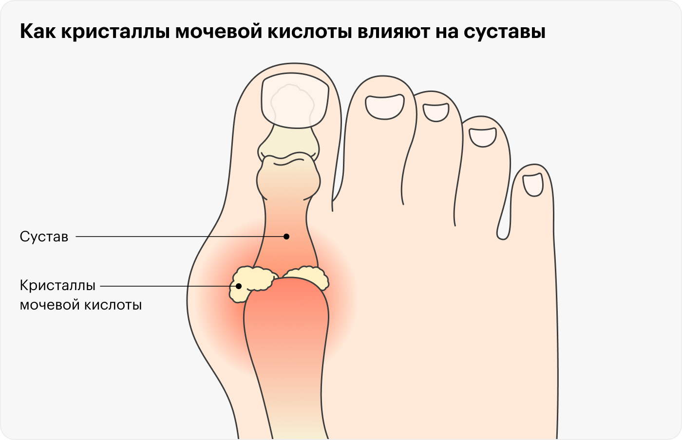 Твердые кристаллы трутся о поверхности сустава и вызывают воспаление. Источник: Baylor College of Medicine