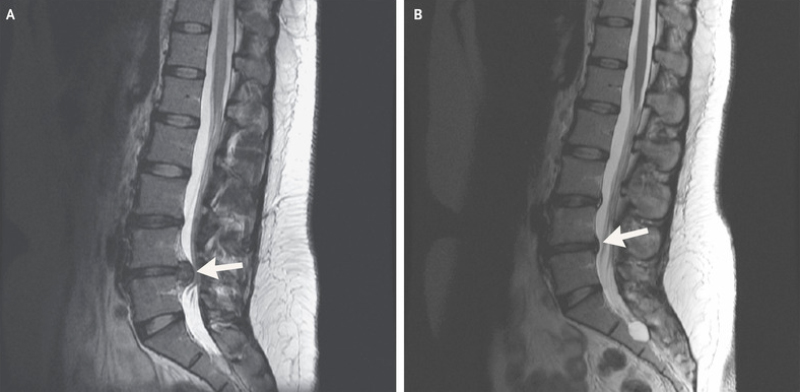 Так может выглядеть межпозвонковая грыжа на МРТ. Источник: nejm.org