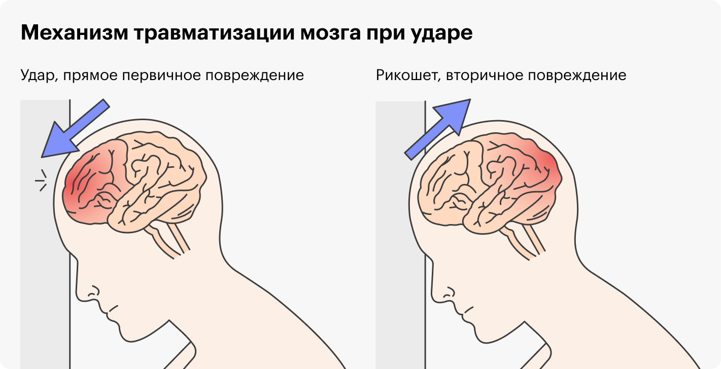 Падение может приводить к травме мозга не только в месте воздействия, но и на противоположной стороне — по принципу противоудара, когда мозг ударяется о внутреннюю поверхность черепа. При травмах с ударно-противоударным механизмом чаще всего поражаются лобные и височные доли