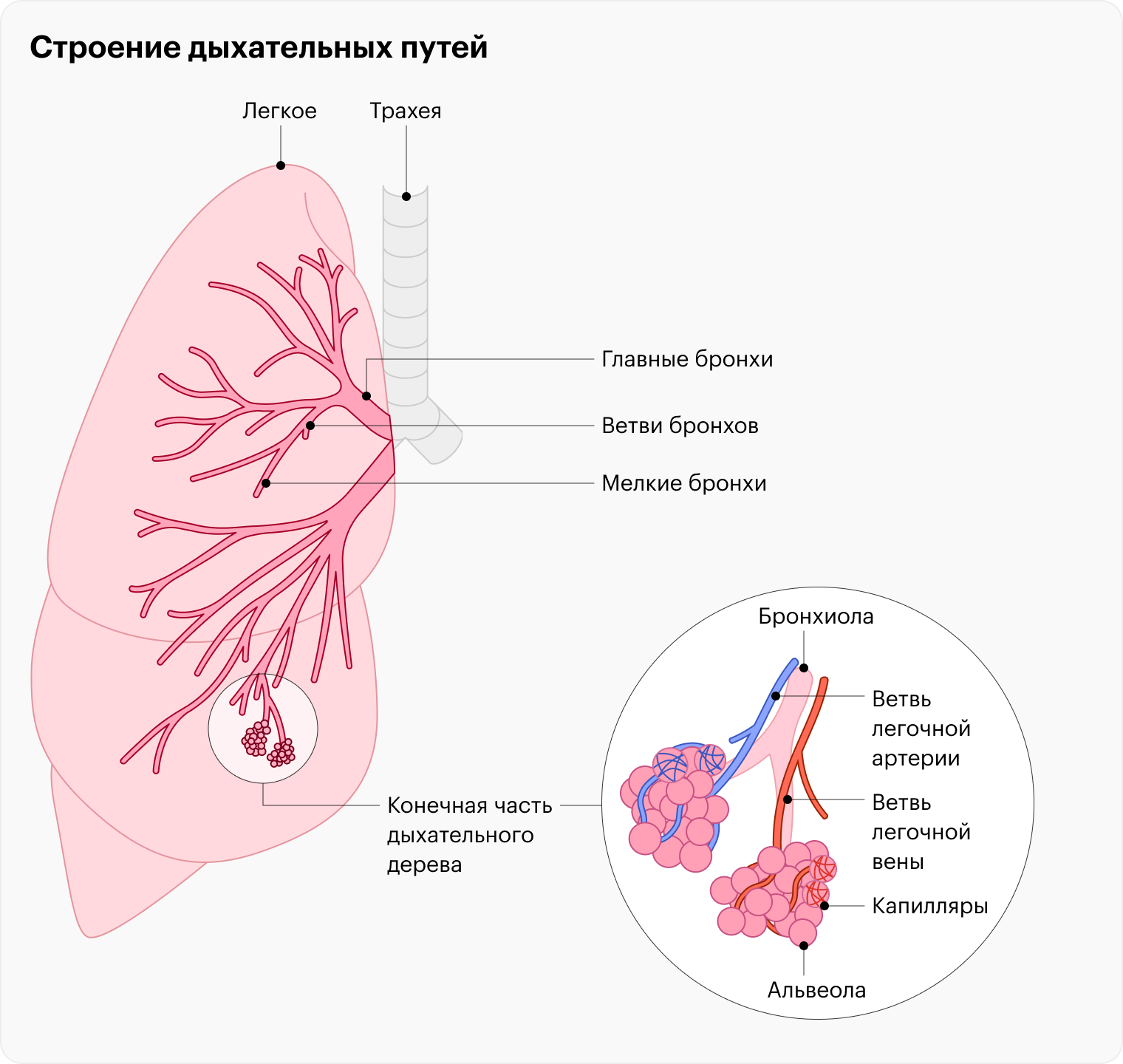 Пневмония часто поражает альвеолы: внутри скапливается воспалительная жидкость