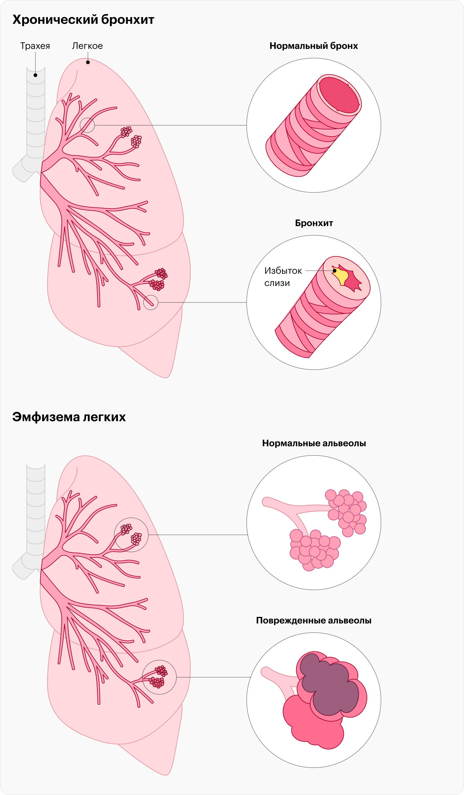 Два процесса, которые происходят при ХОБЛ: хронический бронхит, из⁠-⁠за которого нарушается ток воздуха по бронхам, и эмфизема легких — повреждение альвеол