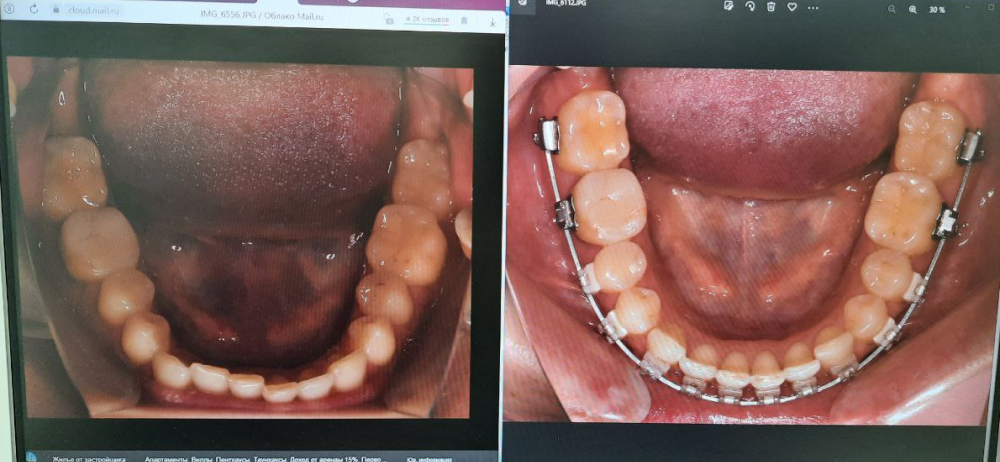 Сравнение зубного ряда в начале лечения в марте 2021 года (слева) и в июле 2022.