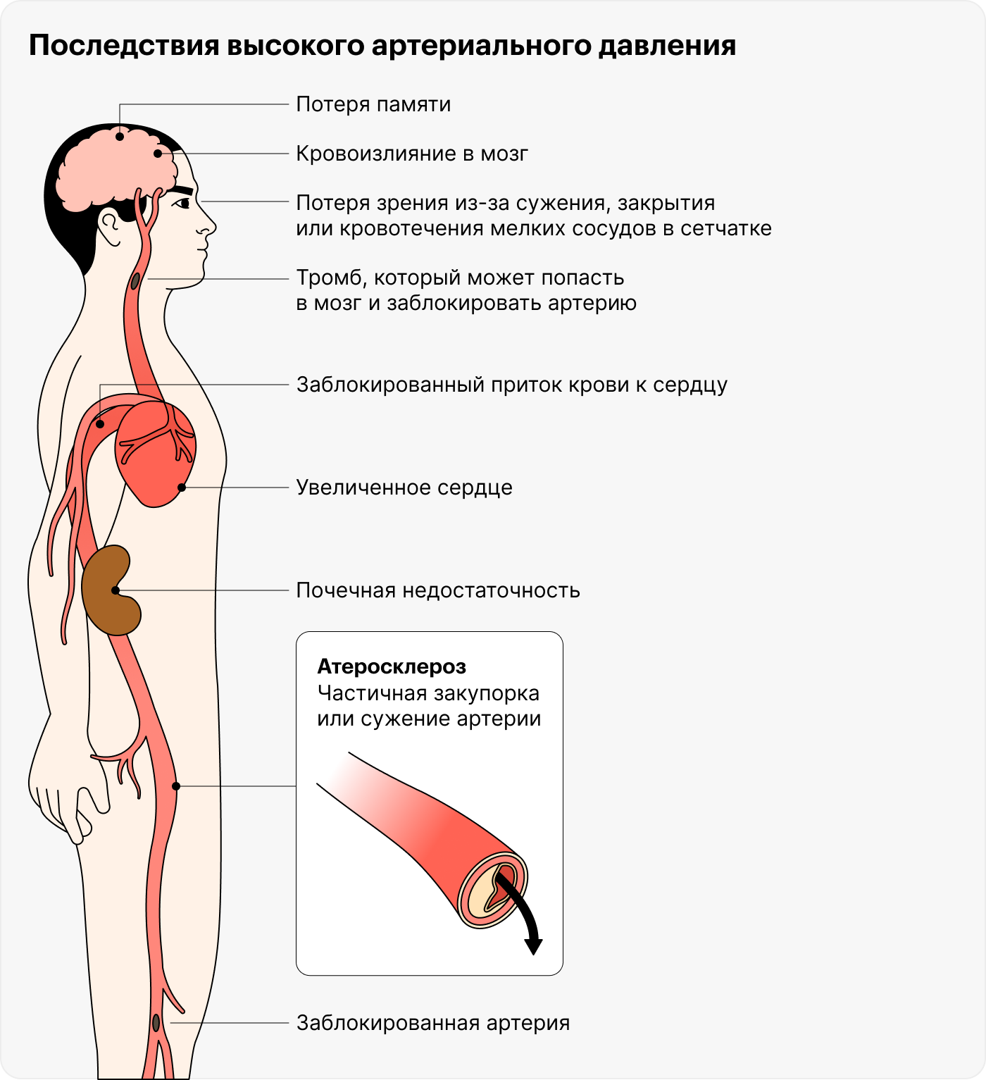 Избыточное кровяное давление повреждает многие кровеносные сосуды, и это нарушает работу многих систем органов