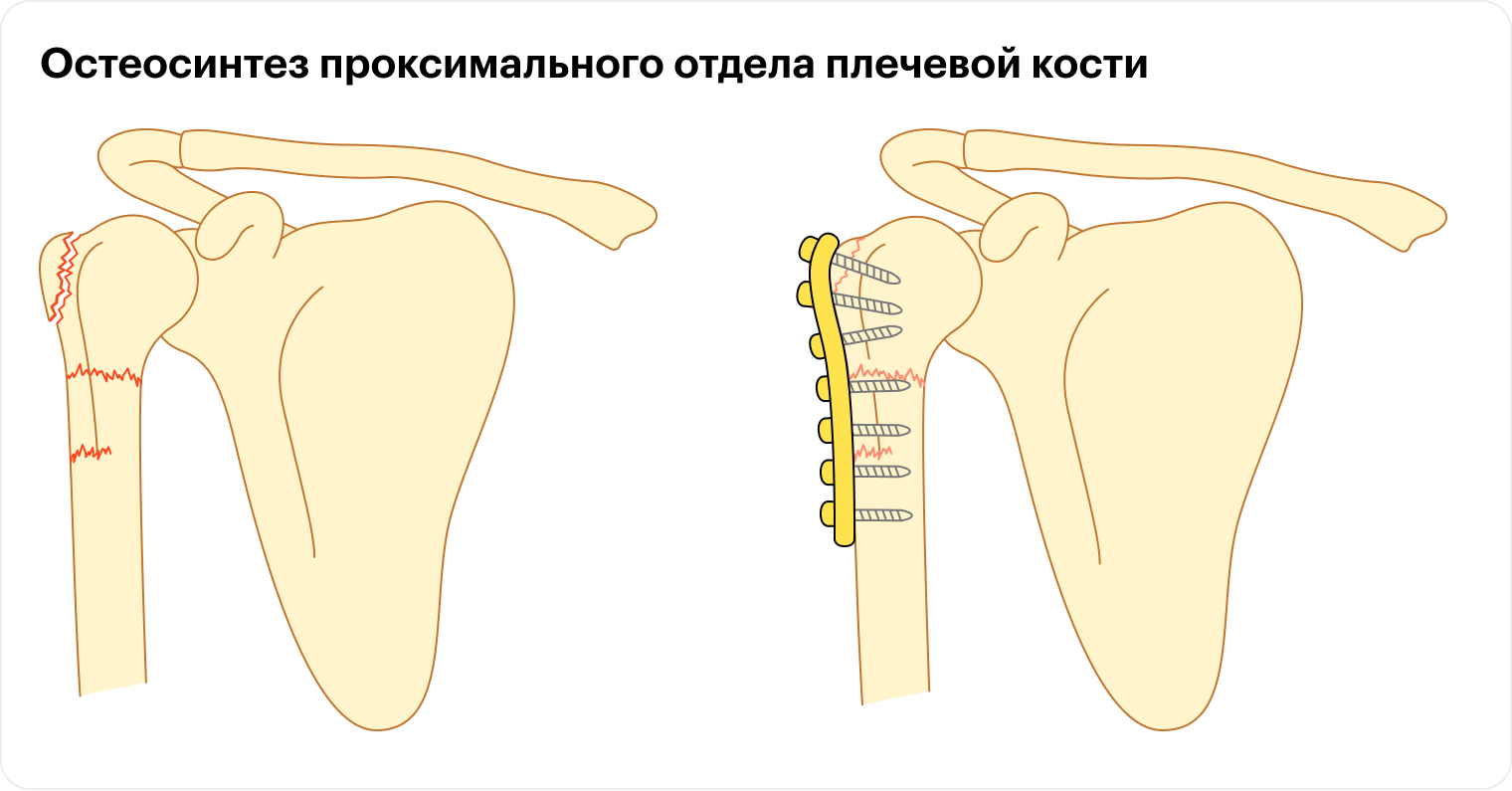 Восстановление плечевой кости с помощью металлических пластин и винтов. Источник: ota.org