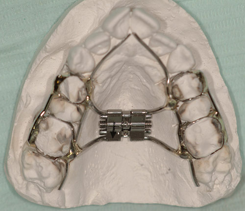 Так выглядит расширитель челюсти — дистрактор. Источник: dentalmagazine.ru