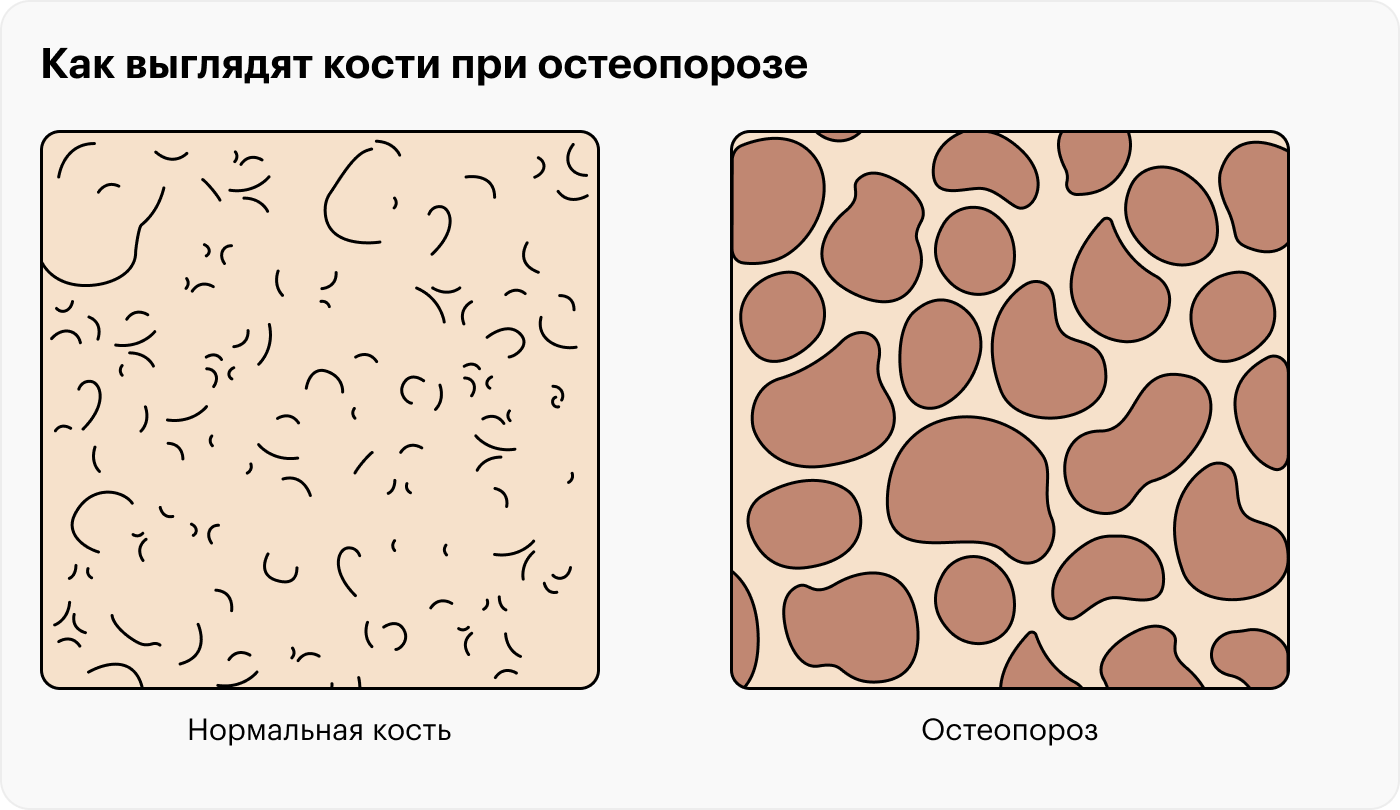 По мере развития остеопороза кости становятся более рыхлыми и хрупкими — это приводит к уменьшению роста и изменению осанки