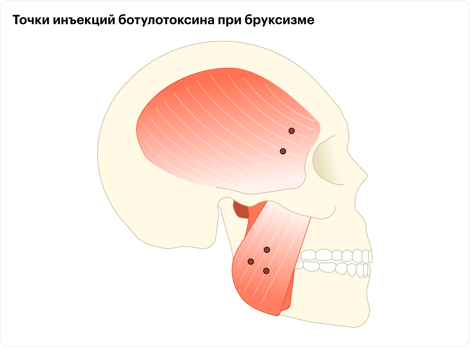 Иногда препарат вводят только в жевательные мышцы, а иногда — в жевательные и височные