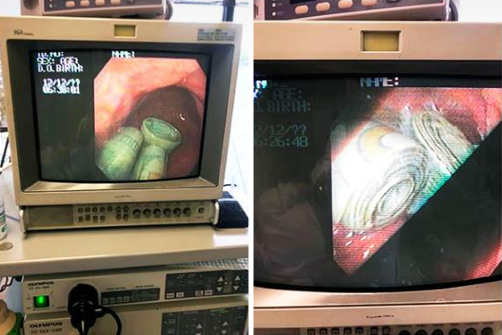 Денежный безоар в желудке на мониторе прибора в операционной. Источник: Колумбийский журнал гастроэнтерологии