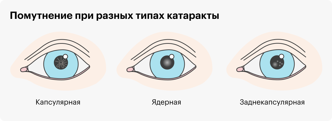 Помутнение при разных типах катаракты будет выглядеть по-разному: при капсулярной оно напоминает расходящиеся лучи, при ядерной располагается в центре зрачка, при заднекапсулярной смещено от центра зрачка