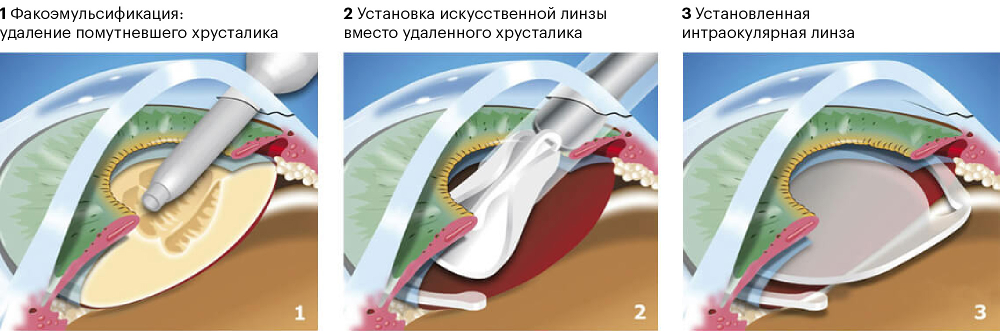 Установка интраокулярной линзы на место помутневшего хрусталика. Источник: iris-center.ru