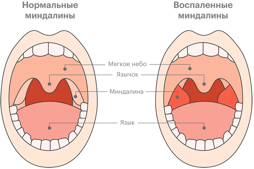 Миндалины расположены по бокам задней стенки глотки. Слева нормальные миндалины, справа — воспаленные