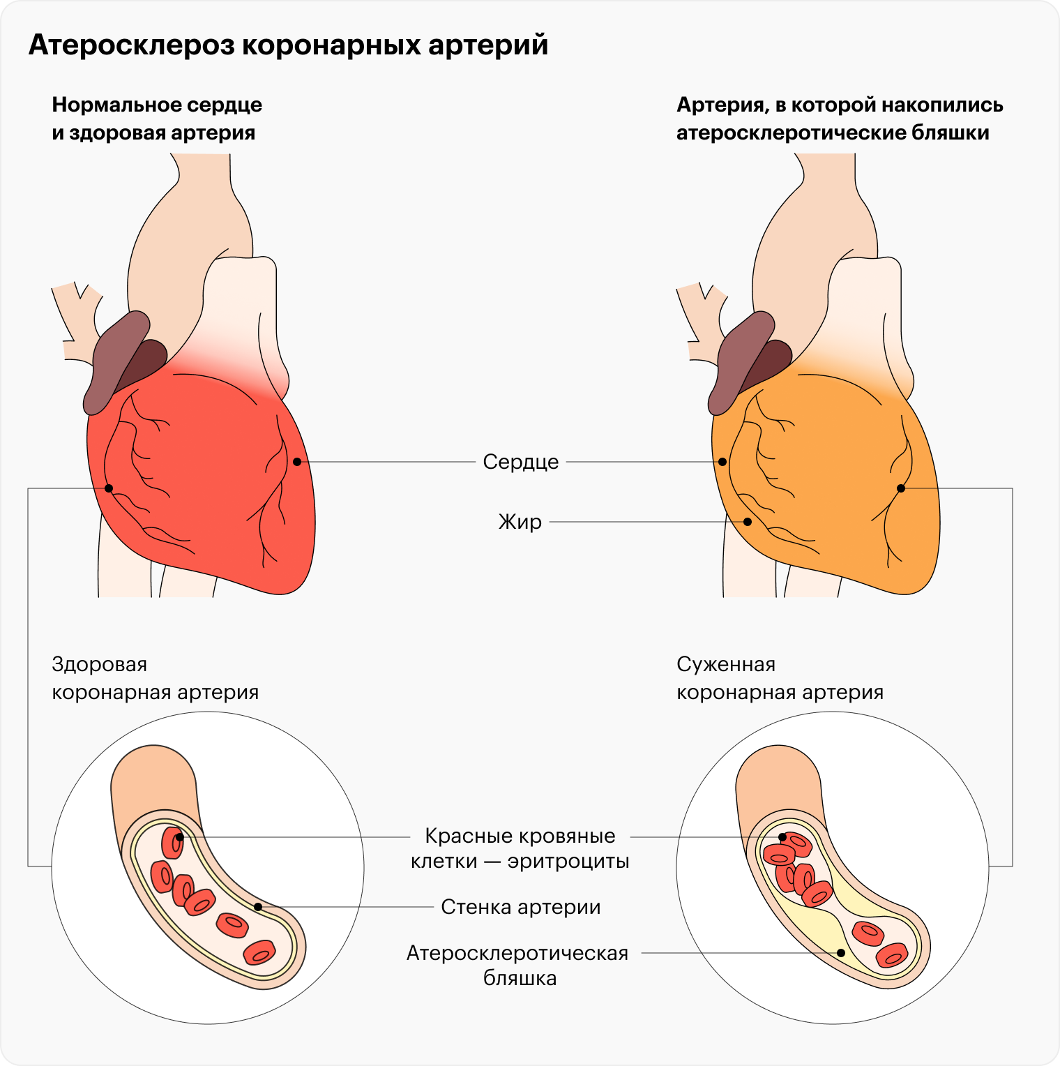 В здоровое сердце поступает необходимое количество насыщенной кислородом крови. К больному сердцу крови поступает меньше из⁠-⁠за суженной артерии, забитой атеросклеротическими бляшками