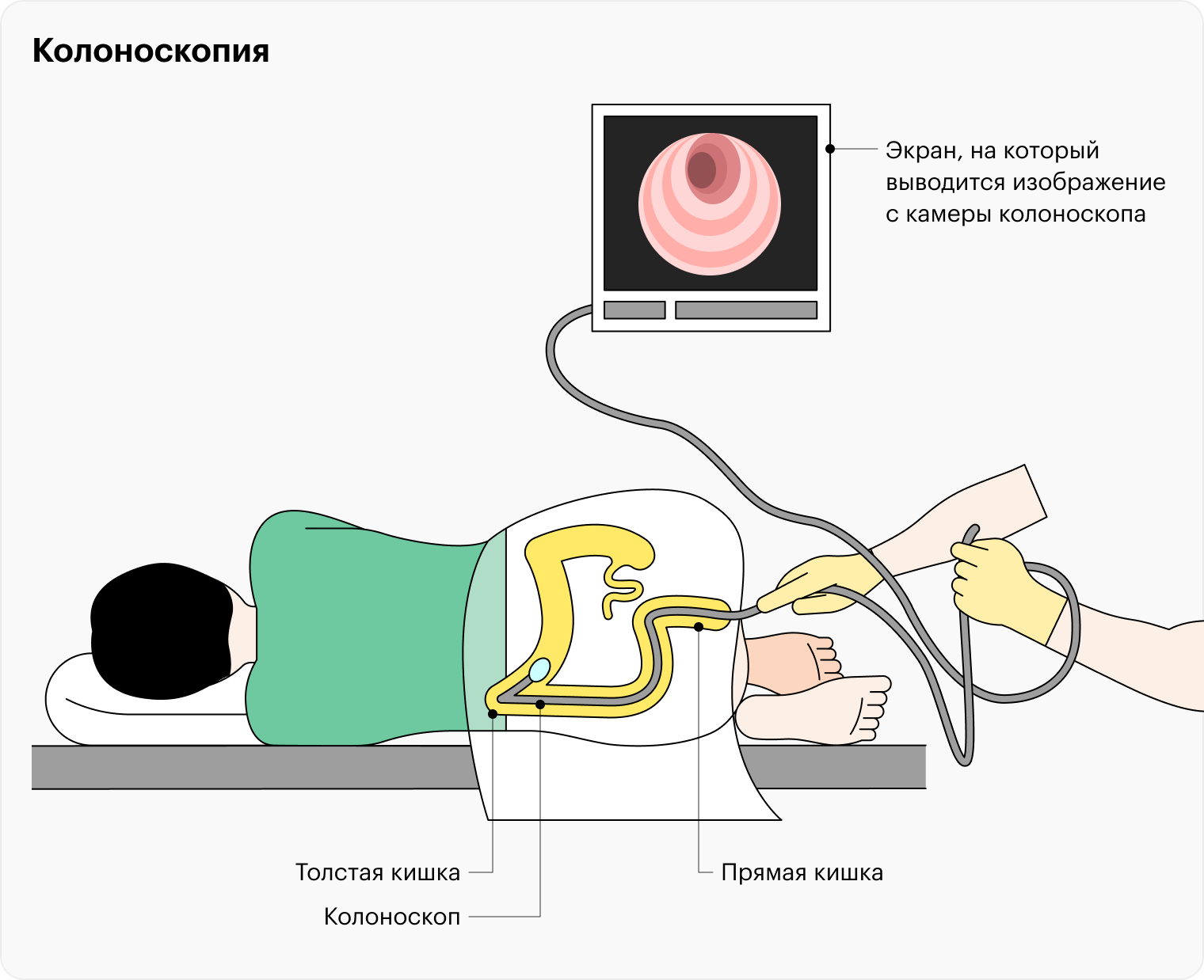 С помощью колоноскопа врач изучает все отделы толстой кишки