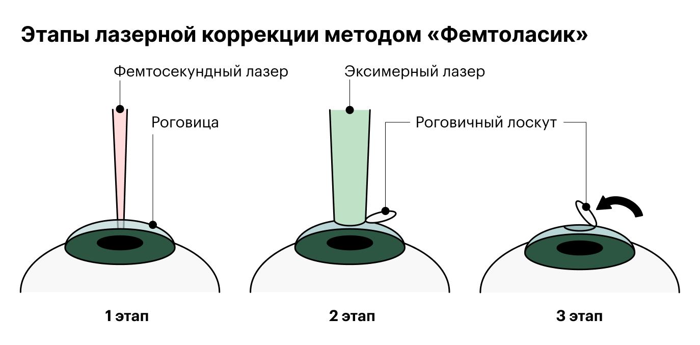 Первый этап — формирование роговичного лоскута фемтосекундным лазером.Второй этап — изменение формы роговицы с помощью эксимерного лазера.Третий этап — возвращение роговичного лоскута на местоИсточник: eyerounds.org