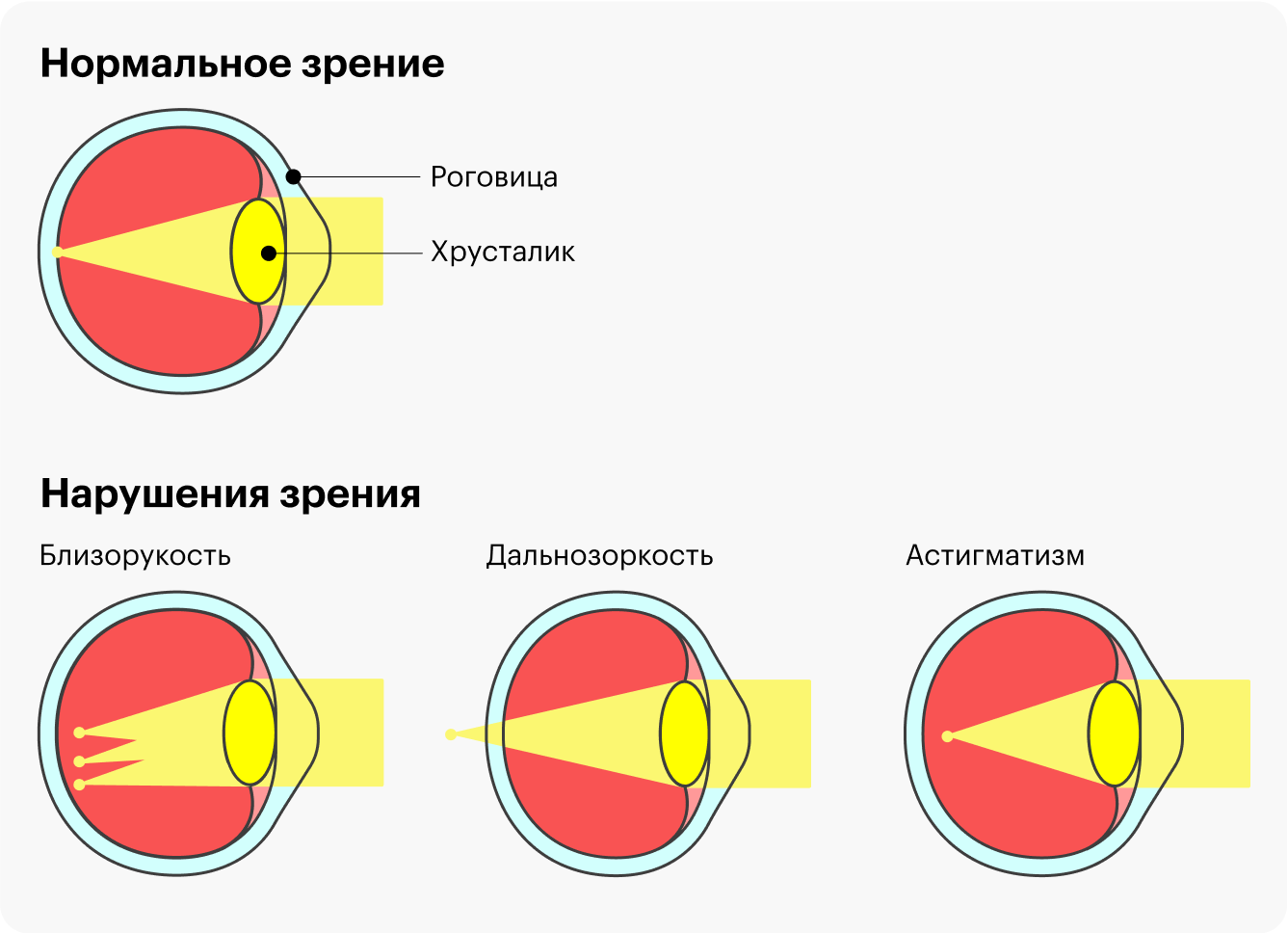 В норме лучи света преломляются через роговицу и хрусталик глаза и сходятся на сетчатке в одной точке. При нарушениях зрения лучи фокусируются перед сетчаткой, за ней или расходятся на несколько пучков. В ходе лазерной коррекции хирург меняет форму роговицы так, чтобы перенаправить лучи в нужное место