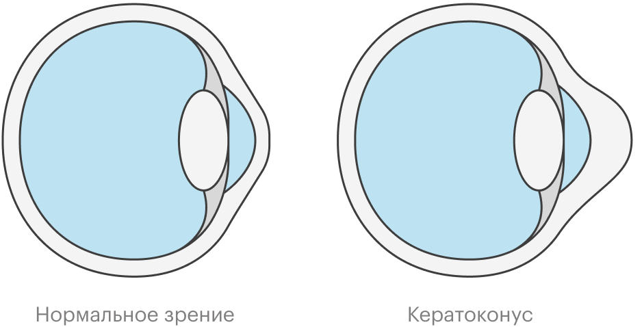 Роговица, которой недостает коллагена, становится жидкой и выпячивается, а человек из⁠-⁠за этого плохо видит