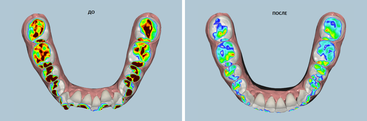 Вот так выглядит окклюзия до и после лечения на элайнерах. Темно⁠-⁠красным отмечены места особого давления
