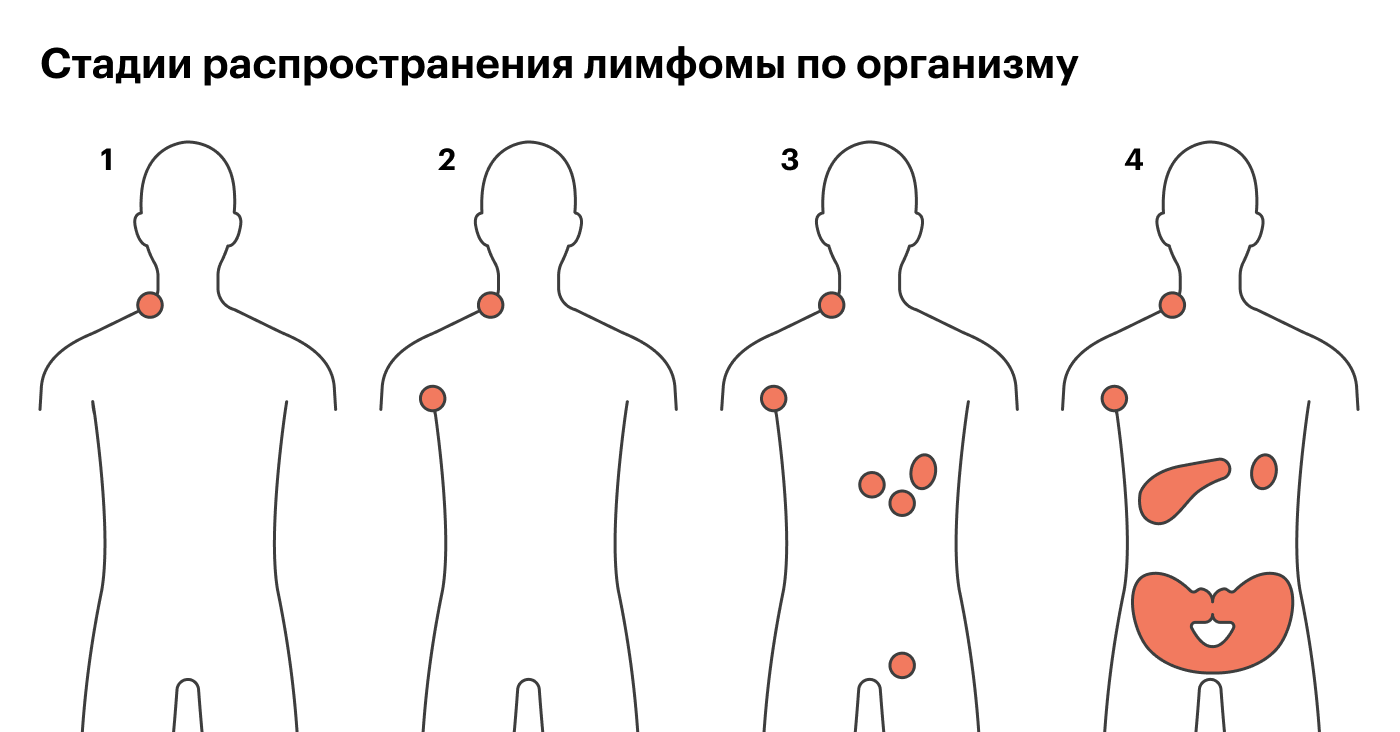 Четыре стадии распространения лимфомы по организму