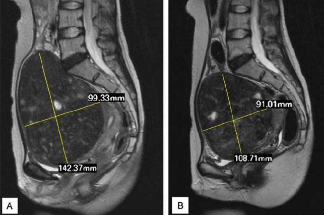МРТ-фото крупной фибромы. Миомы могут достигать такого же размера, заполняя всю полость малого таза. Источник