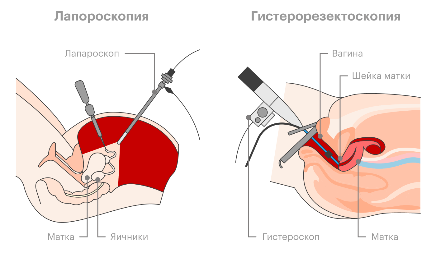 Лапаротомическое удаление миоматозных узлов выглядит как обычная полостная операция с разрезом на животе. При лапароскопической операции хирург вводит гибкие трубки через разрезы на животе, при гистерорезектоскопической — через влагалище, вовсе без разрезов