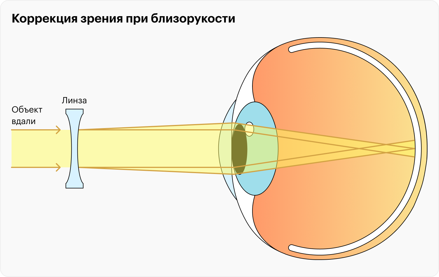 Вогнутые линзы собирают на сетчатке расходящиеся лучи света, позволяя человеку с близорукостью нормально видеть не только вблизи, но и вдалеке