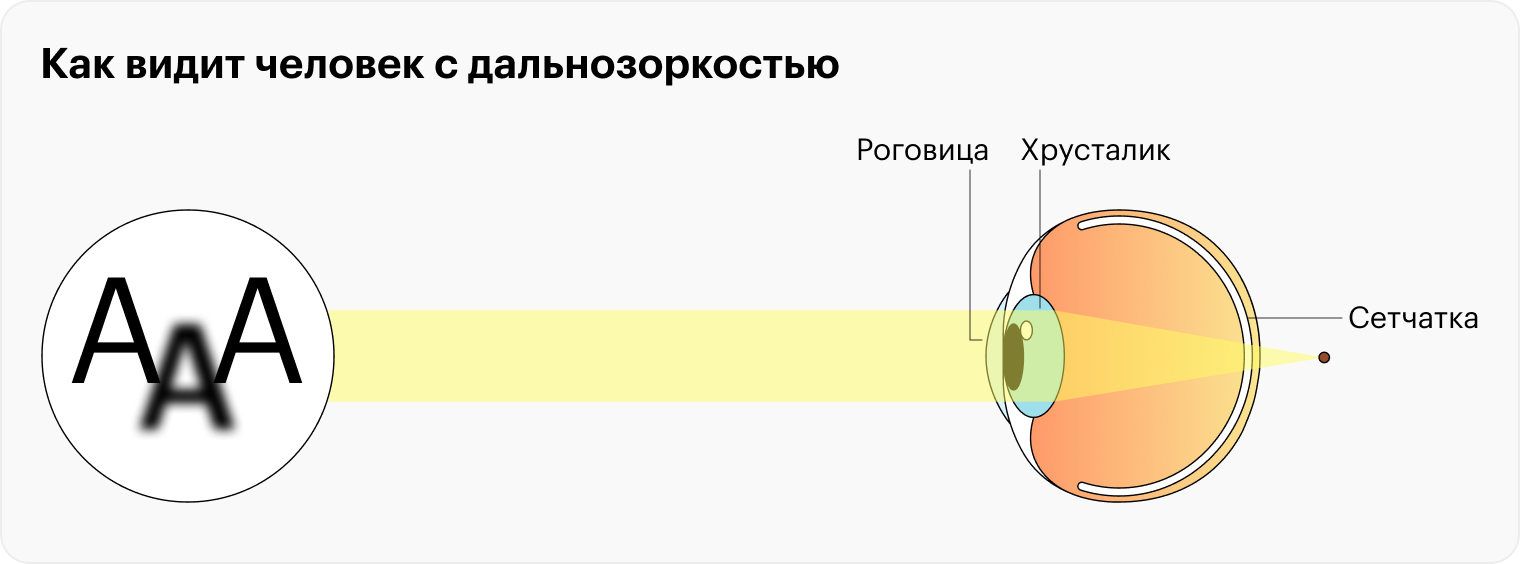 У людей с дальнозоркостью изображение формируется не на сетчатке, а за ней