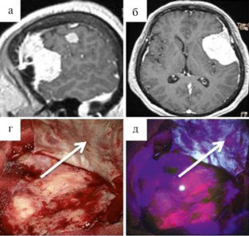 В лобно-височной области большая опухоль. Под буквами а и б она видна на томографии. Под буквой г — фото во время операции. А под буквой д видно, что при флуоресцентном освещении ткани опухоли отличаются по цвету от здоровых тканей мозга. Источник: журнал «Вопросы нейрохирургии имени Бурденко»