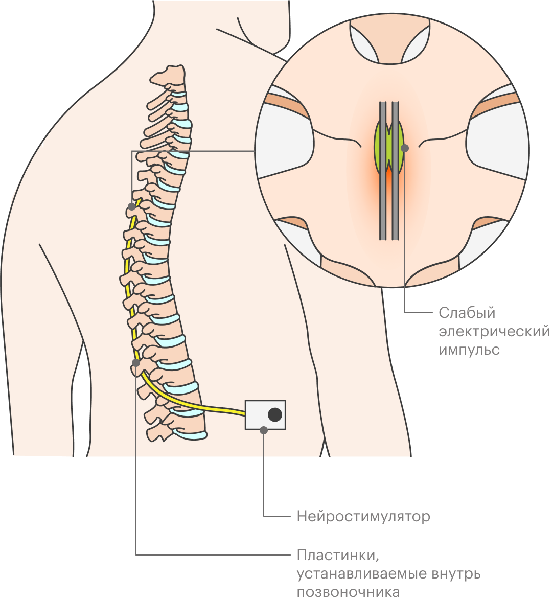 Электростимуляция спинного мозга позволяет лечить хронические болевые синдромы, с которыми не справиться другими способами