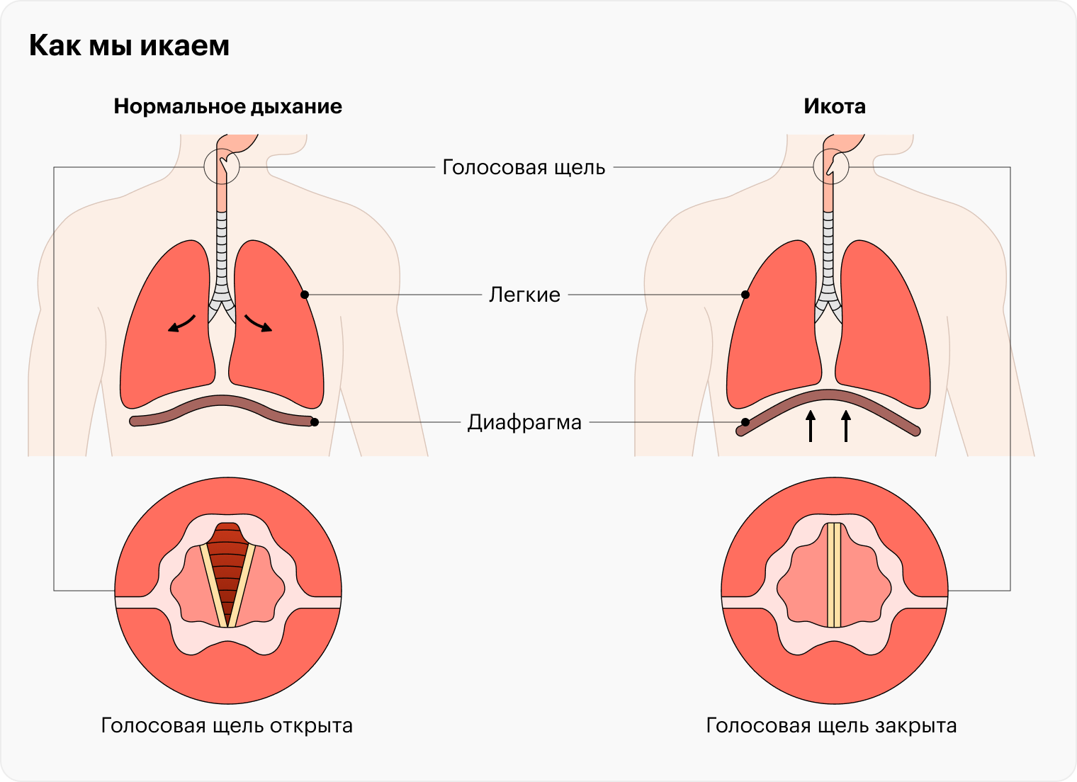 Спазм диафрагмы заставляет голосовые связки ненадолго закрываться, издавая звук «ик»