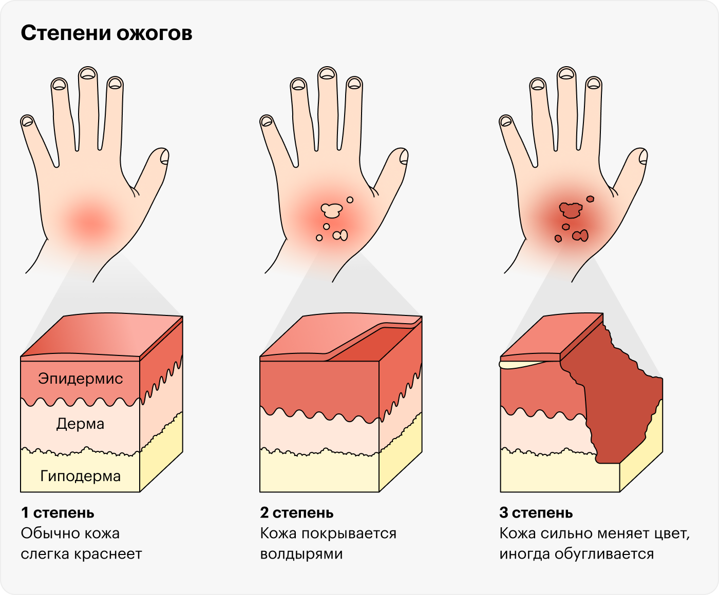 При ожоге первой степени кожа обычно лишь слегка краснеет, при второй степени покрывается волдырями, а при третьей сильно меняет цвет и иногда обугливается