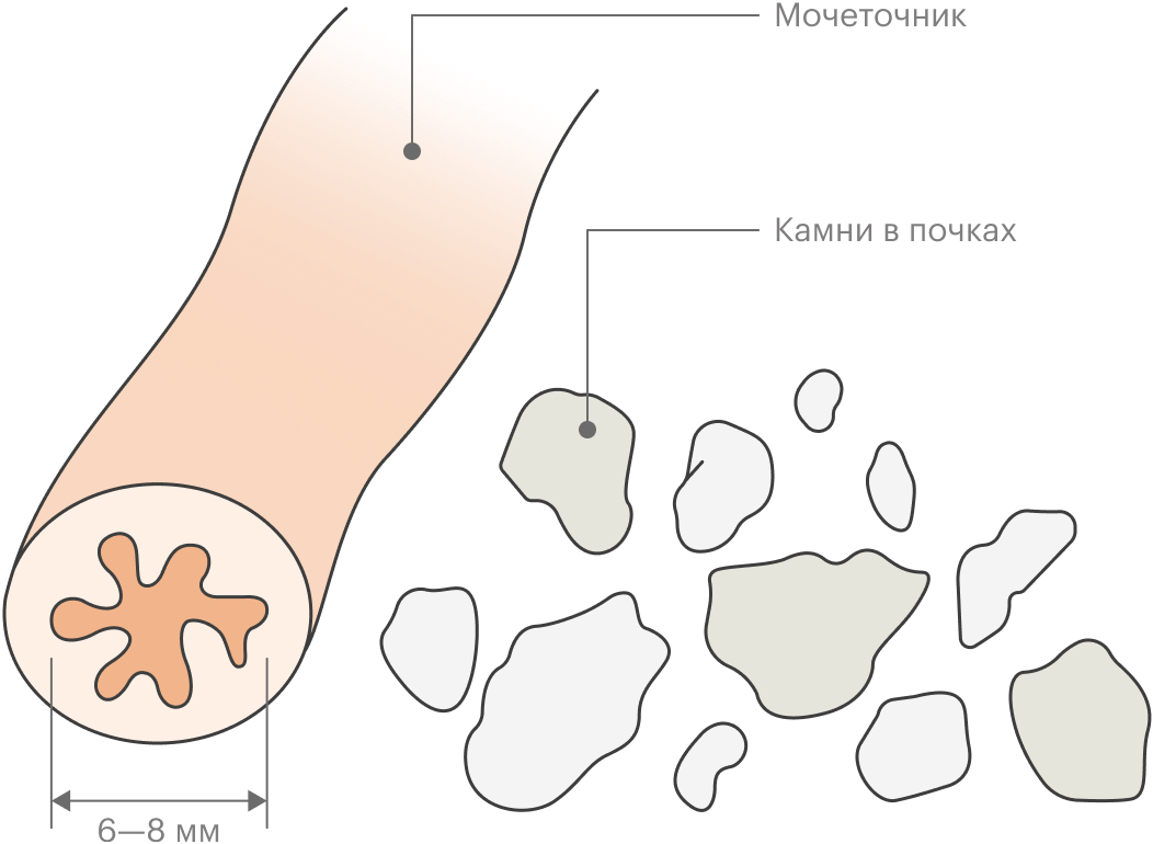 Диаметр мочеточника — 6⁠—⁠8 мм, так что «песок» покидает их безболезненно