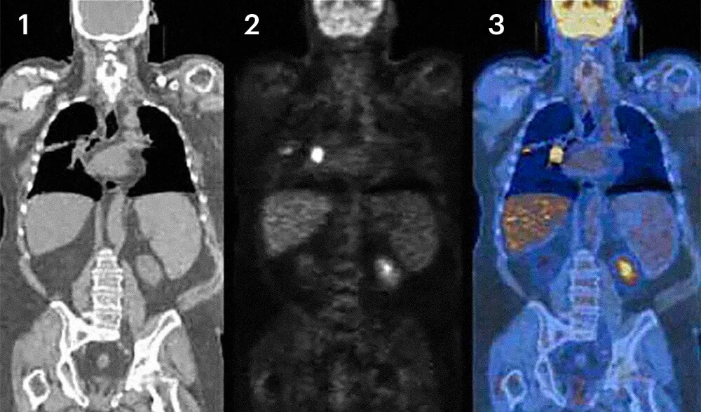 При ПЭТ-КТ совмещают изображения, полученные с помощью обычной компьютерной томографии (1) и позитронно-эмиссионной томографии (2), которая показывает уровень обмена в клетках: у раковых клеток он повышен, они видны в виде ярких очагов. На совмещенном снимке (3) хорошо видны внутренние органы, а яркий очаг в груди — это рак легкого. Источник: Клиника Майо
