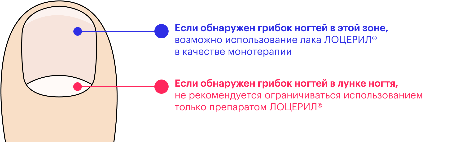 На сайте «Лоцерила» есть предупреждение, что в запущенных случаях препарат может не справиться в одиночку. Я все это пропустил мимо и потом долго ругался, что средство «не помогает». Понимаю теперь: сам дурак