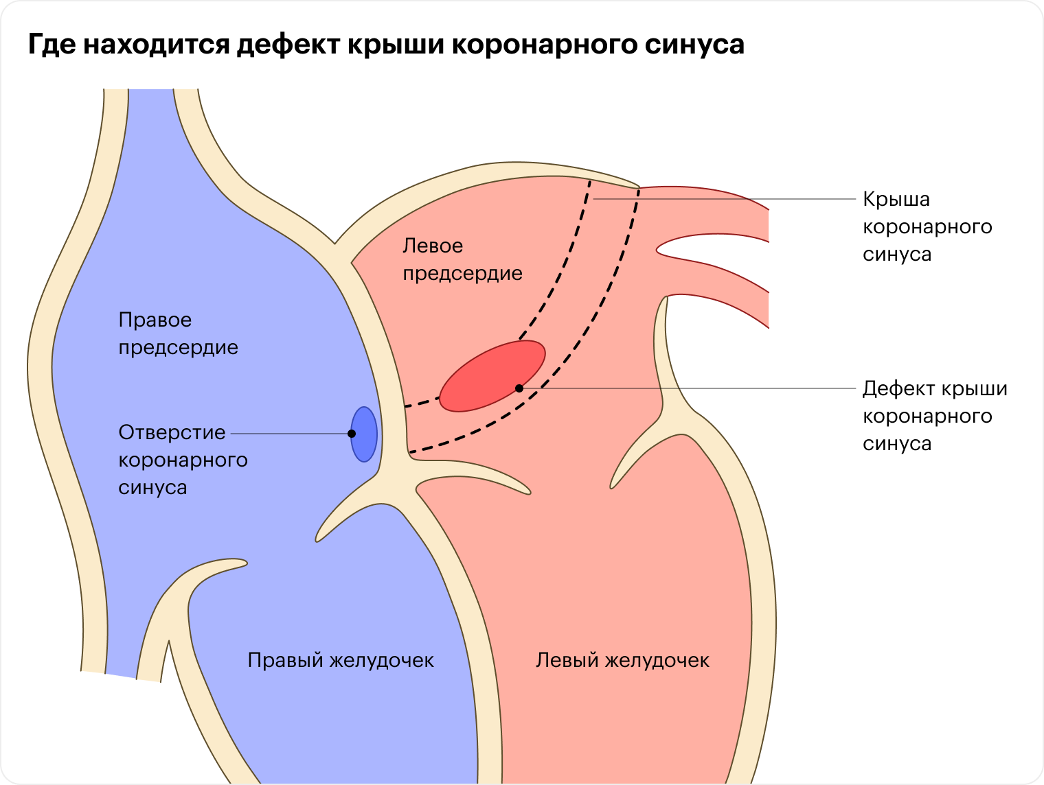 У здоровых людей при сокращении левого предсердия кровь поступает только в левый желудочек. А у людей с обескрышенным коронарным синусом — в желудочек и синус. Из⁠-⁠за этого правое предсердие перегружается. В малом круге кровообращения возрастает объем крови, что может приводить к повреждению легочных сосудов