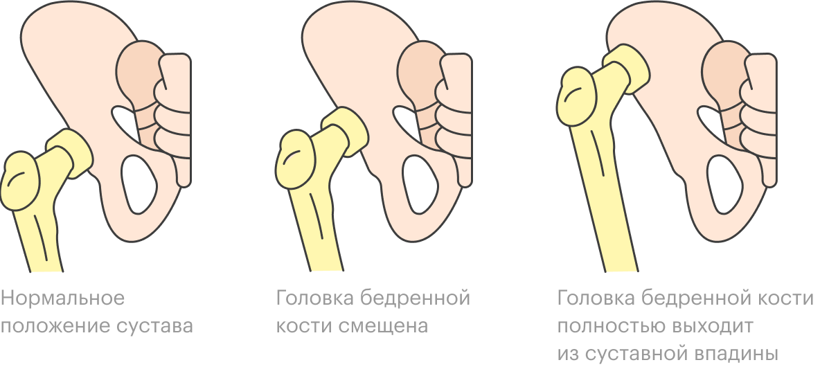 Слева — нормальный тазобедренный сустав. При дисплазии сустав развивается неправильно, головка бедренной кости смещена, иногда полностью выходит из суставной впадины. Если не лечить дисплазию в первые месяцы ребенка, то в будущем, скорее всего, возникнут нарушения походки, ранние артриты и артрозы тазобедренных суставов и другие проблемы