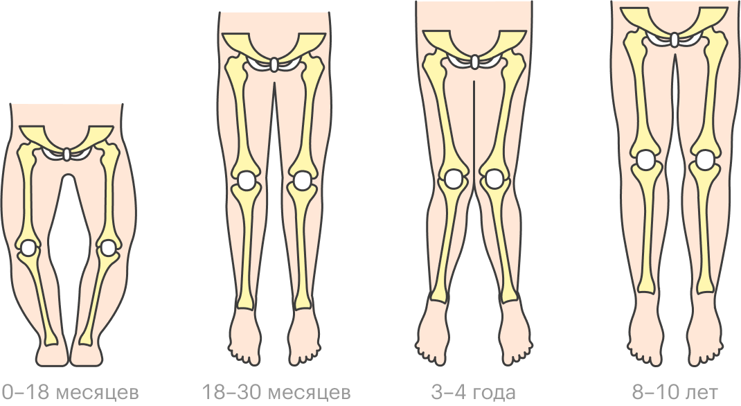 Обычно О-образная и Х-образная деформация ног — варианты возрастной нормы, и положение ног выправится само по себе