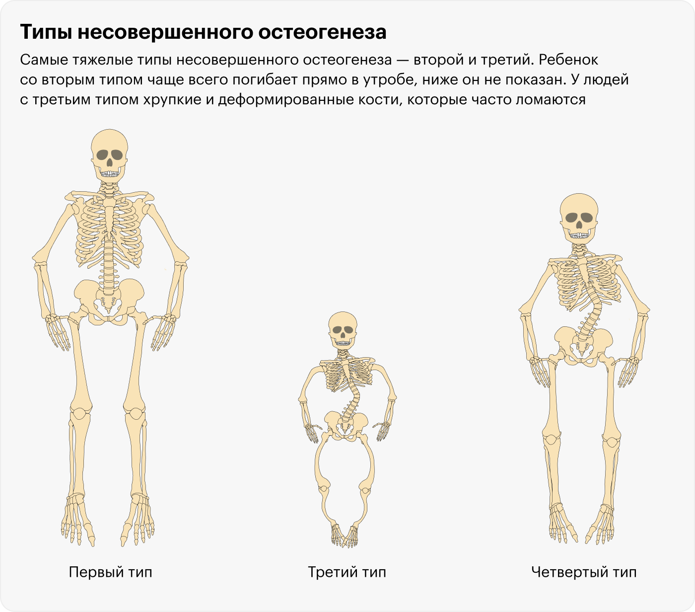 Чаще всего у людей с несовершенным остеогенезом первый тип болезни. Внешне их трудно отличить от здорового человека