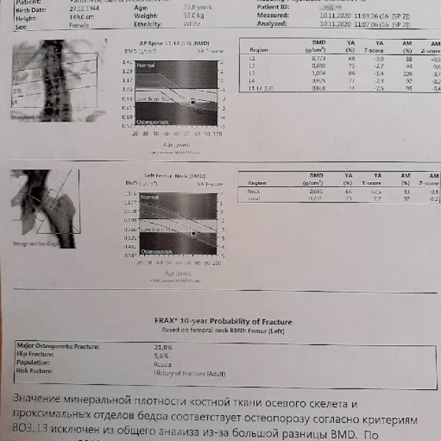 Пример реальной денситометрии — исследование плотности костной ткани позвоночника и шейки бедра. Картинка слева нужна, чтобы специалист верно установил аппарат над пациентом, а не для диагностики. Здесь у пациентки Т⁠-⁠критерий в шейке бедра и суммарный по позвоночнику — −2,5. Это говорит о том, что у нее остеопороз