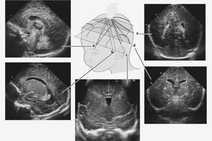 Нейросонография — это фактически УЗИ головного мозга. Орган смотрят через отверстие родничка, оценивают размеры и расположение разных структур. Источник: radiologykey.com