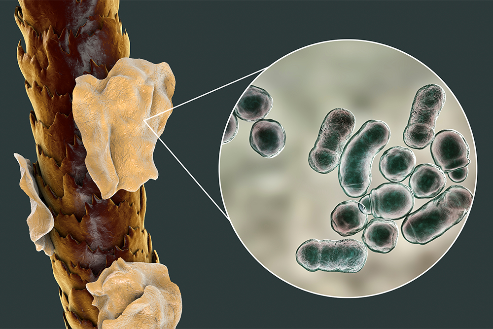 Человеческие волосы с перхотью и микроскопический грибок Malassezia furfur, вызывающих образование крупных чешуек. Источник: Kateryna Kon / Shutterstock