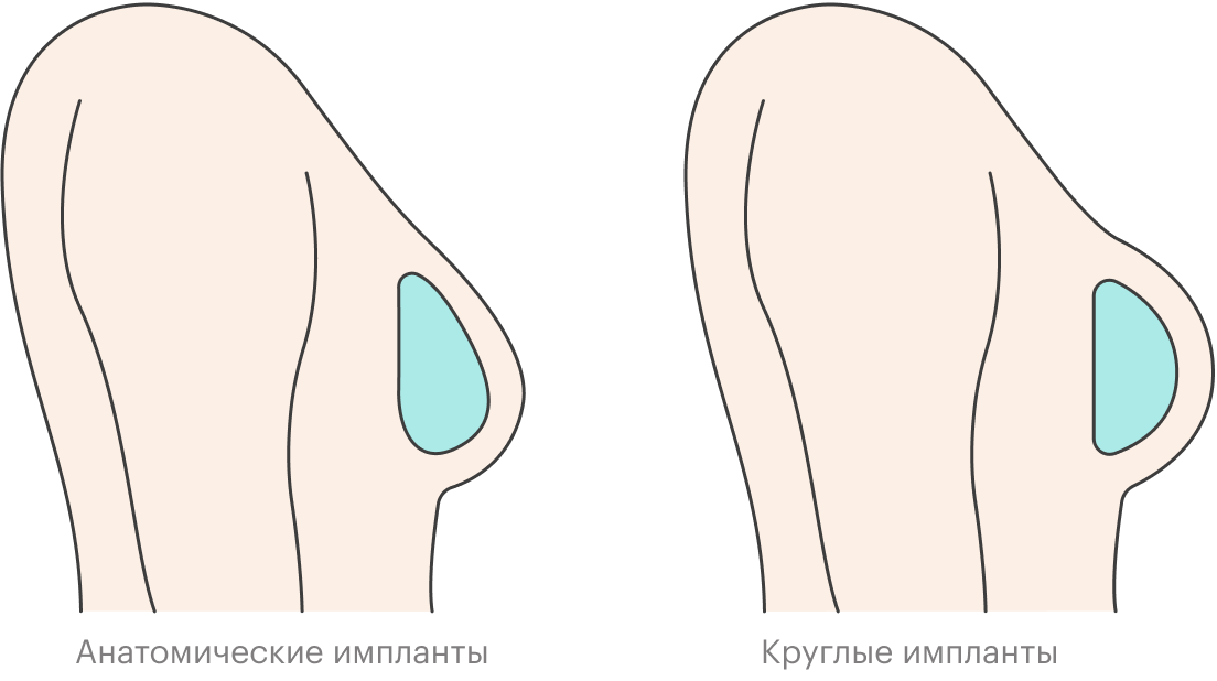 Анатомические импланты выглядят более естественно. Круглые обеспечивают больший эффект пуш⁠-⁠ап