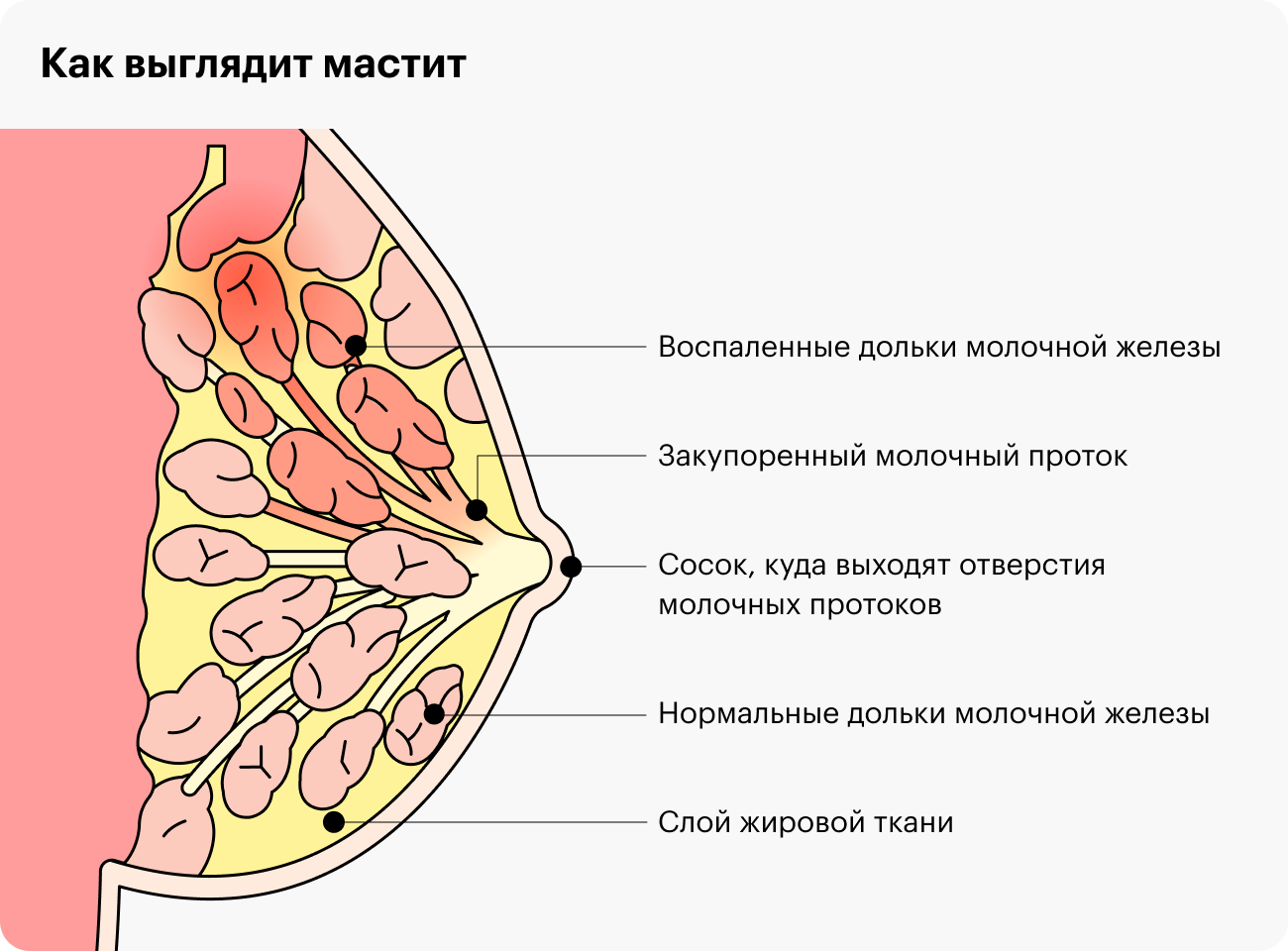 Если грудное молоко не выходит из долек груди, там может развиться воспаление