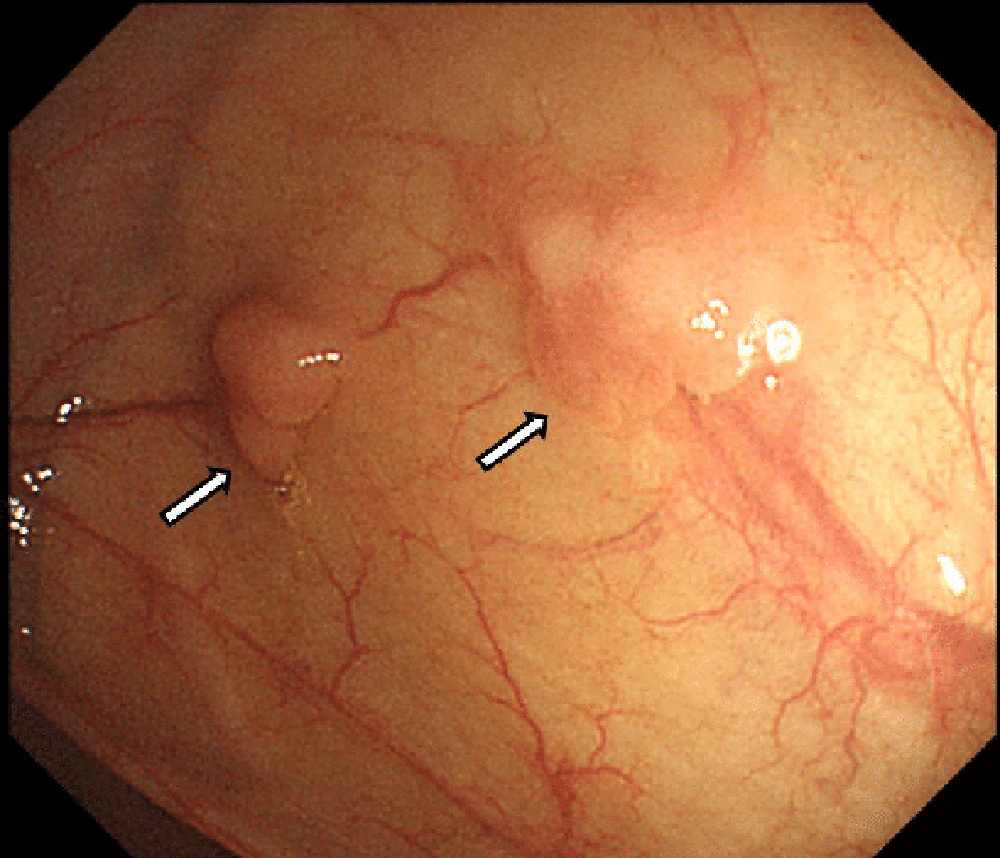 Так могут выглядеть полипы толстой кишки на колоноскопии. Источник: Researchgate