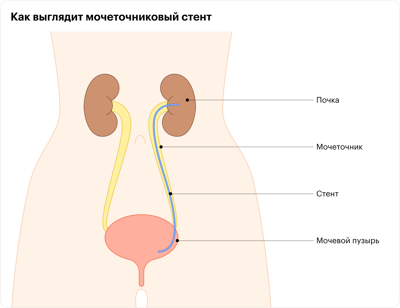 Мочеточниковый стент — полая трубка с двумя завитыми концами, которая устанавливается в мочеточник для облегчения оттока мочи из почки