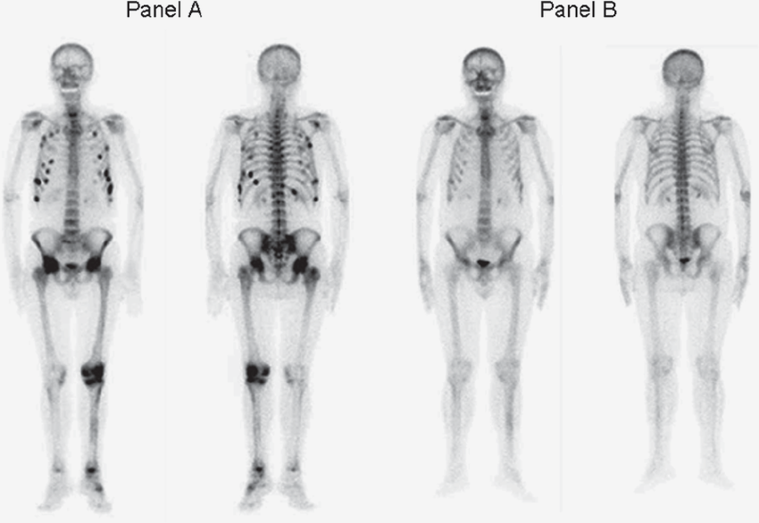 На этой остеосцинтиграфии видны изменения в костях. Но это не рак, а множественные стрессовые переломы. Источник: researchgate.net