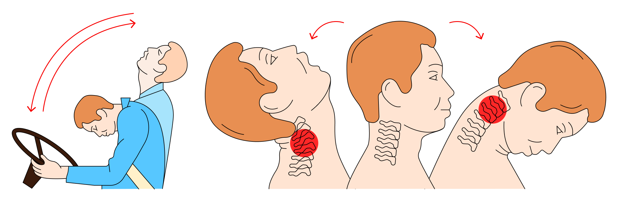 Хлыстовая травма шеи может произойти во время резкого торможения машины